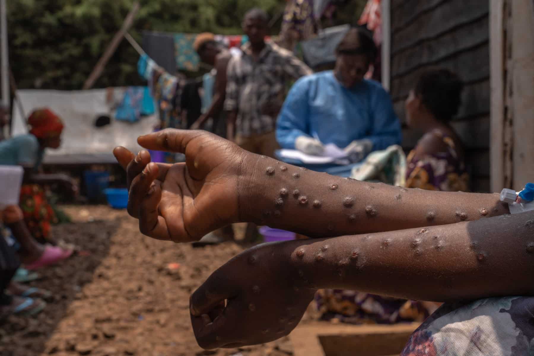 Sierra Leone reports more than 2,000 Mpox cases, 11 deaths